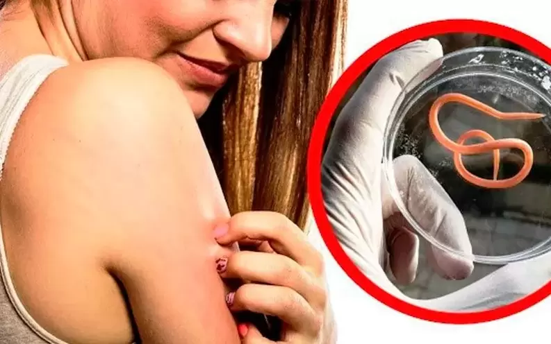 picazón e irritación debido a parásitos en el cuerpo