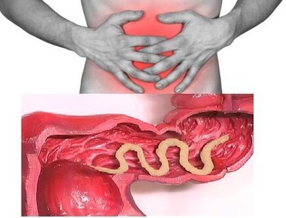 Los signos de helmintiasis crónica son un trastorno intestinal dispéptico. 