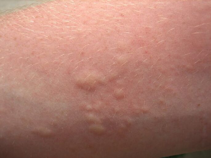 erupciones cutáneas alérgicas con picazón pueden ser síntomas de ascariasis