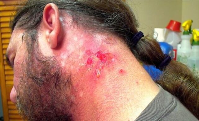 Herida sangrante en el cuello con virus Morgellons