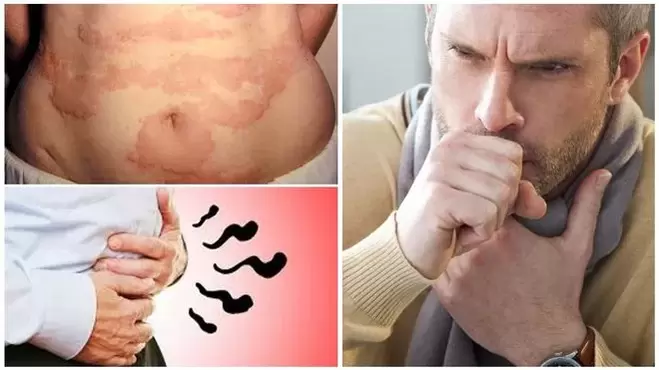 Las alergias, la tos y la hinchazón son signos de daño al cuerpo por gusanos. 